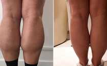 Уменьшение икроножных мышц ботоксом
