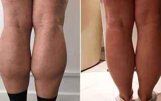 Уменьшение икроножных мышц ботоксом