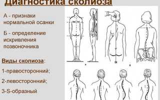 Упражнения и гимнастика после эндопротезирования тазобедренного сустава
