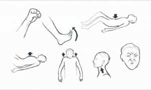Нервно-мышечная релаксация по Джекобсону