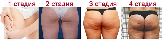 4 стадии целлюлита