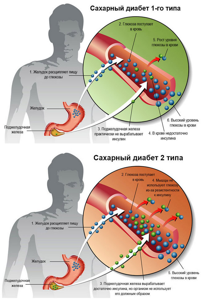 Сахарный диабет 1 и 2 типа