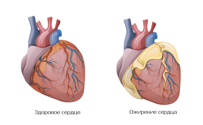 Ожирение сердца